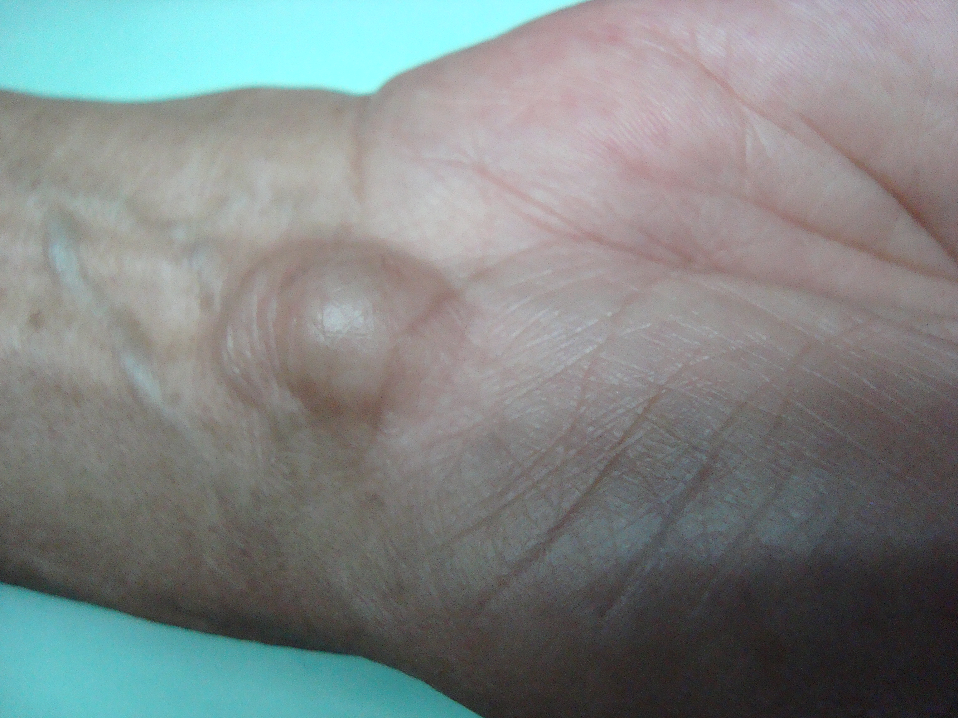 what is a ganglion cyst