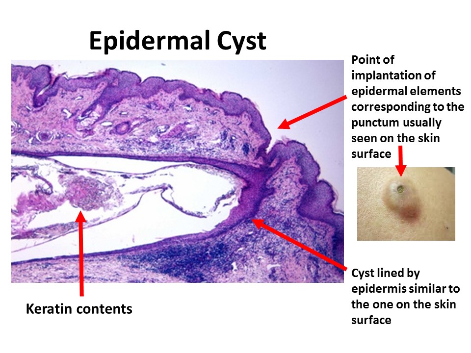 Epidermal Cyst