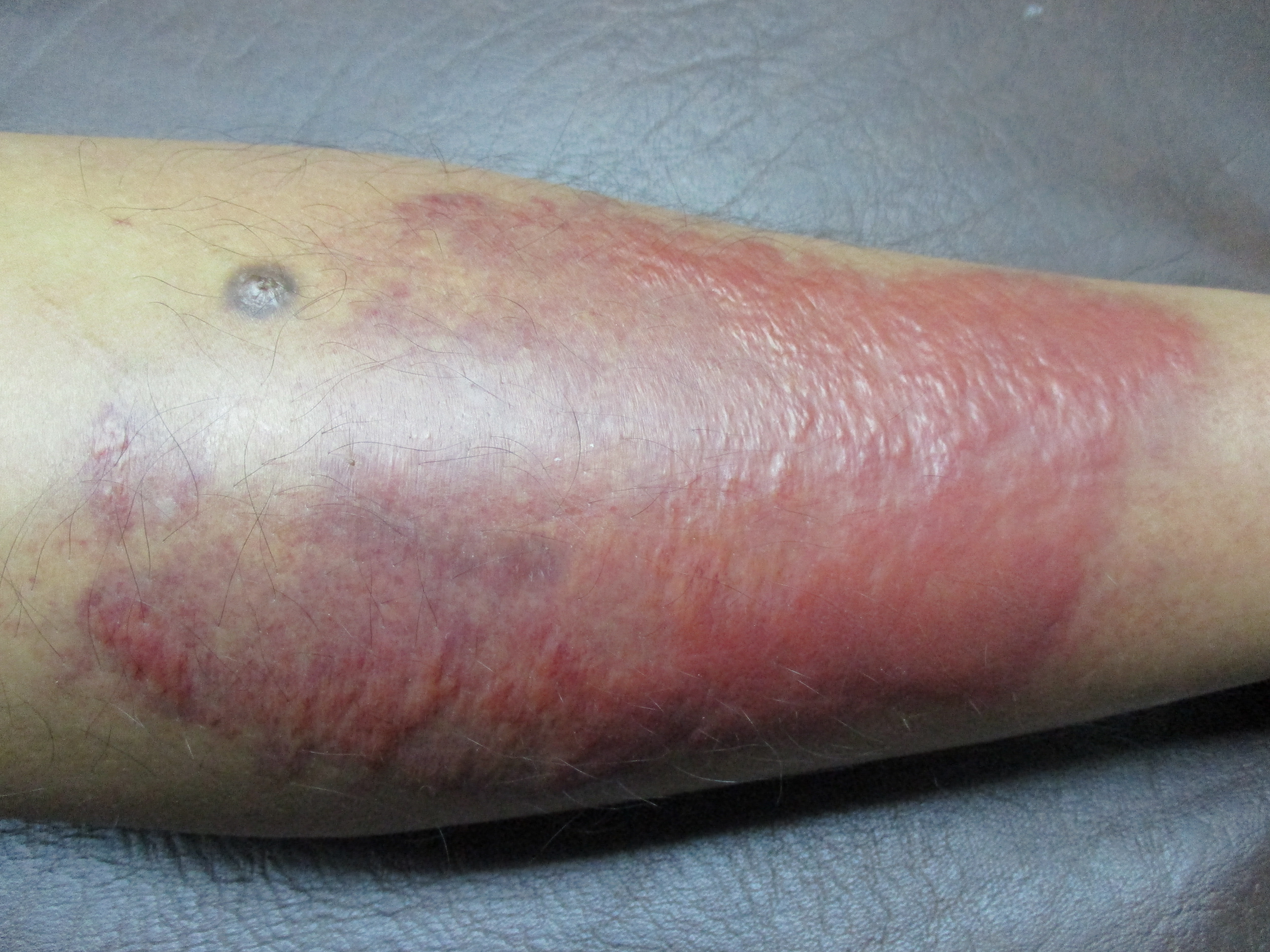 Cellulitis in Adults: Condition, Treatments, and Pictures ...