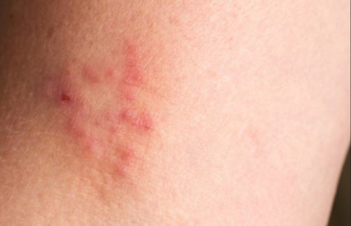 Ringworms-in-armpit-may-cause-underarm-rash